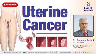 Uterine Cancer  Types Stages Cause Symptoms Risk Factor Diagnosis amp Treatment [upl. by Onairotciv572]