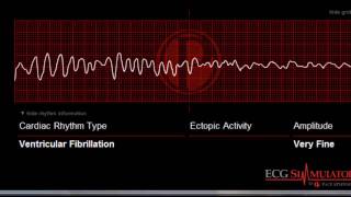 Ventricular Fibrillation ECG  EKG ecgsimulatornet [upl. by Tiphany]