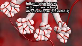 Pulmonary Embolism narration and animation by Cal Shipley MD [upl. by Aenahs]