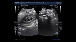 Ultrasound Video showing focusing of two stones in the ureter [upl. by Esoryram]