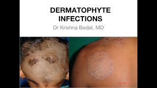 Dermatophyte infections of Skin [upl. by Madson738]