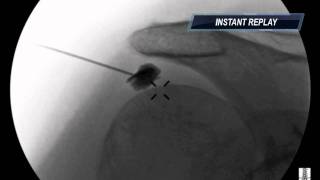 Subacromial Injection under Fluoroscopy  ThePainSourcecom [upl. by Jeunesse]