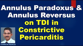 Annulus paradoxus and annulus reversus on tissue Doppler in constrictive pericarditis [upl. by Atinhoj]