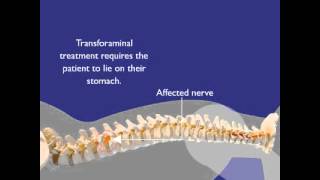 Epidural steroid injection transforaminal approachmov [upl. by Foskett741]