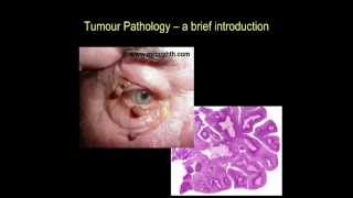 Tumour pathology  a brief introduction part II [upl. by Anelas639]