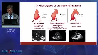 L’insuffisance aortique  du diagnostic au traitement [upl. by Web]