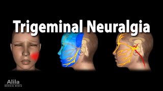 Trigeminal Neuralgia Tic Douloureux Animation [upl. by Cook]