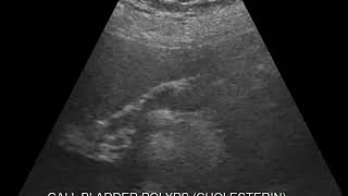 CASE 462 GALL BLADDER CHOLESTEROLOSIS [upl. by Ahsimal]