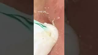 Pickel Ausdrücken Spa  Blackheads Akne amp Mitesser entfernen 🔴 32 [upl. by Oijile248]