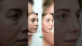 Blepharoplasty Recovery  Day 5 after surgery [upl. by Theone]