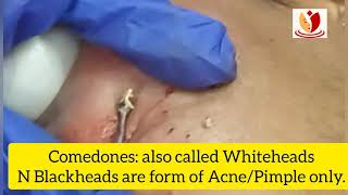 ComedonesWhiteheads and Blackheads removal treatment by comedone extractor Results before n after [upl. by Ennagrom]