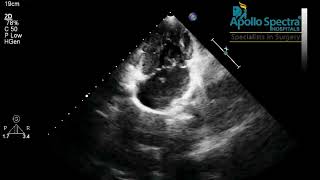 COMPLETE AV CANAL DEFECT Singel ventricular most rare heart defect [upl. by Cyna186]