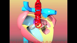 Congenital heart defects III HLHS  Hypoplastic Left Heart Syndrome [upl. by Immac]