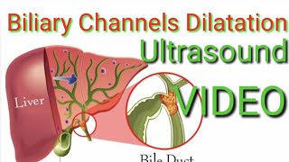 INTRA HEPATIC BILIARY DILATATION Ultrasound VIDEO demonstration [upl. by Adnolahs]