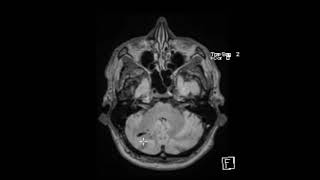 Venous Angioma developmental venous malformation [upl. by Aviv]