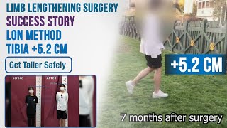 Limb Lengthening Surgery Success Story  52 cm LON Tibia [upl. by Yuma]