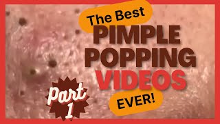 The BEST pimple POPPING videos EVER p1 [upl. by Orapma918]