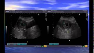 Gestational age assessment by US  Dr Hussein Abo El Makarem [upl. by Ostler]