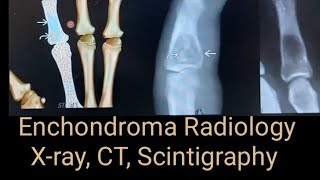 Enchondroma Radiology x ray CT and Scintigraphy Study points [upl. by Vivianna]