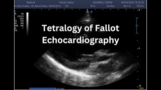 Tetralogy of Fallot  Point of Care ECHO  Short Video [upl. by Colston553]