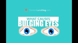 BULGING EYES  Causes Symptoms and Treatment  Exophthalmos Exopthalmia Exorbitsm and Proptosis [upl. by Atinrev]