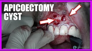 Apicoectomy Cyst SURGERY [upl. by Faxen]