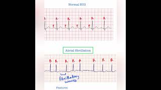 Atrial fibrillation ECG  USMLE Step 1 amp 2 [upl. by Halsted]