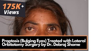 Proptosis Bulging Eyes Treated with Lateral Orbitotomy Surgery by Dr Debraj Shome [upl. by Akli]