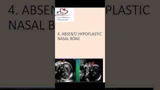 Absent or hypoplastic nasal bone an antenatal scan nasalbone hypoplasticnasalbone [upl. by Hardi]