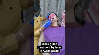 Black gum treatment by laser in Aurangabad gum depigmentation gingival bleaching melanosis treatmen [upl. by Enirehtahc]