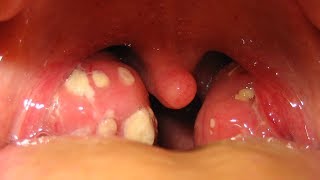 How To Remove Tonsil Stones [upl. by Mellins490]