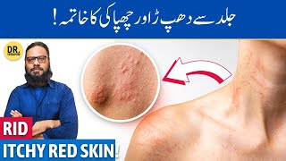 KharishDhapper Ka Ilaj  Treat UrticariaHives on Skin  Dr Ibrahim [upl. by Farris]