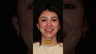 Composite Bonding vs Porcelain Veneers [upl. by Inafit]