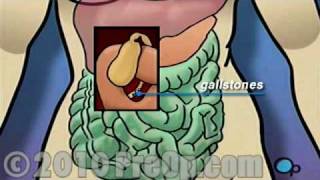 Gallbladder Removal Laparoscopic PreOp® Patient Education Feature [upl. by Garvy563]