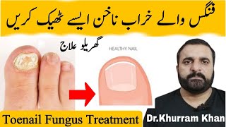 Toenail Fungus Treatment خراب ناخن کا علاج  DrKhurram RPh  toenailfungustreatment [upl. by Knipe958]