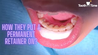 how do they put a permanent retainer on Braces at Tooth Time Family Dentistry New Braunfels [upl. by Yenttihw614]