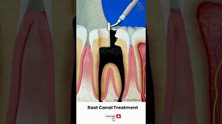 ROOT CANAL TREATMENT PROCEDURE3D MEDICAL ANIMATION dentist trending viralvideo dentalclinic [upl. by Orest775]