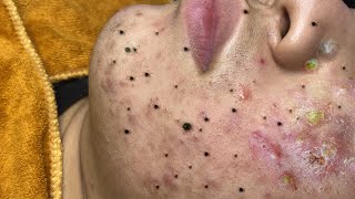 Big Cystic Acne Blackheads Extraction Blackheads amp Milia Whiteheads Removal Pimple Popping  6820 [upl. by Ecyned333]