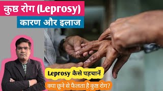 Leprosy कुष्ठ रोग Cause Symptoms and Treatment  लेप्रोसी के खतरे एवं बचाव [upl. by Valaria]