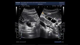 Multiple Polyps in the Gallbladder [upl. by Channing833]