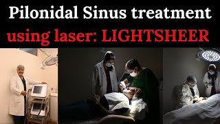 Pilonidal Sinus treatment using laser LIGHTSHEER  Advanced Wellness  laser [upl. by Nary]