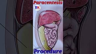 Paracentesis procedures medicineknowledgehindi short [upl. by Kane]