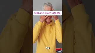 Signs of liver disease [upl. by Nylde]