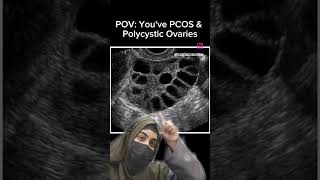 😀Polycystic Ovaries is a common symptom of PCOS Suxh ultrasound shows that you have PCOS pcos [upl. by Ansley]