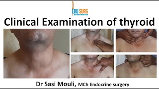 Clinical examination of thyroid swelling  An OSCE guide  MBBS MRCS  Surgery clinics [upl. by Mahla918]