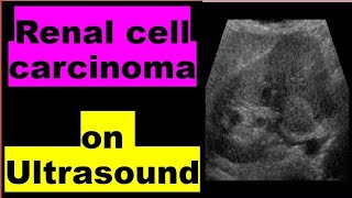 Renal cell carcinoma on Ultrasound [upl. by Telocin]