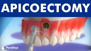 Apicoectomy  Treatment of root canal infection © [upl. by Sherry]