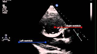 3B Parasternal long axis view of the left ventricle pulmonary hypertension [upl. by Jolene]