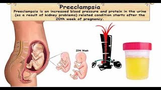 HELLP syndrome and preeclampsia [upl. by Essirehs583]