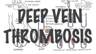 Deep Vein Thrombosis  Overview pathophysiology treatment complications [upl. by Iow]